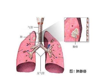 肺腺癌深度解析与应对策略